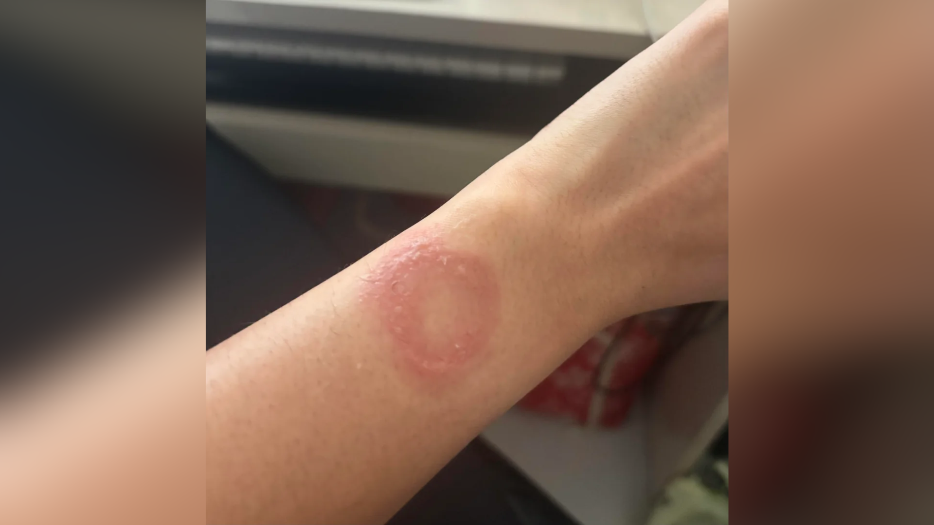 Apple Watch User Alleges Severe Burn from Overheating, Criticizes Six Months of Unresolved Apple Support